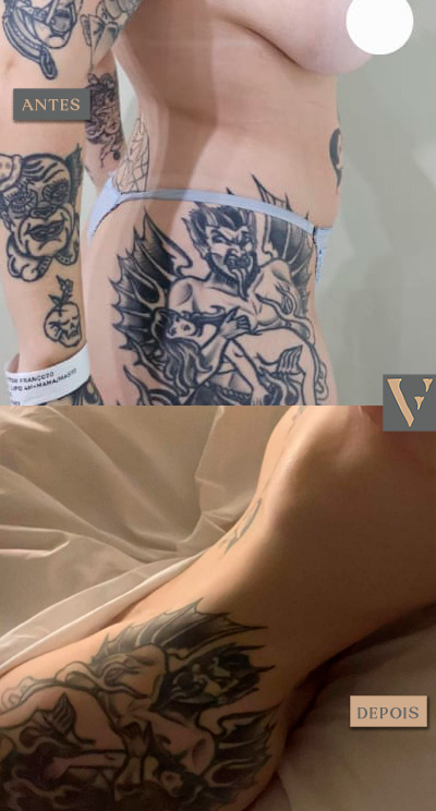 Lipoaspiração antes e depois Dr Vitor Francozo