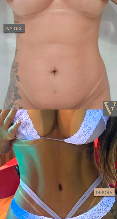 Lipoescultuta antes e depois Dr Vitor Francozo