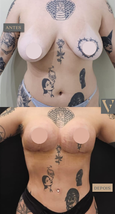 Lipoaspiração e mastopexia antes e depois Dr Vitor Francozo