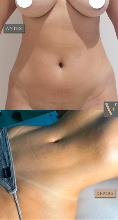 Lipoescultura antes e depois Dr Vitor Francozo