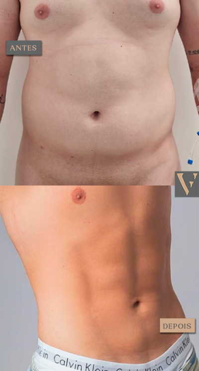 Lipoescultura masculino antes e depois Dr Vitor Francozo