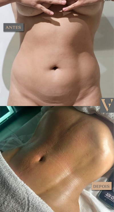 Lipoescultura antes e depois Dr Vitor Francozo