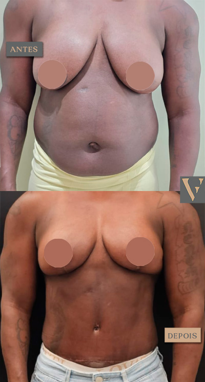 Mommy Makeover antes e depois Dr Vitor Francozo
