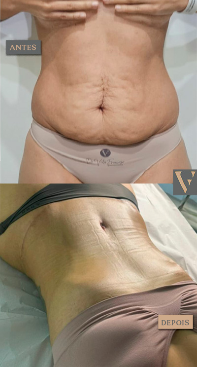 abdominoplastia antes e depois Dr Vitor Francozo