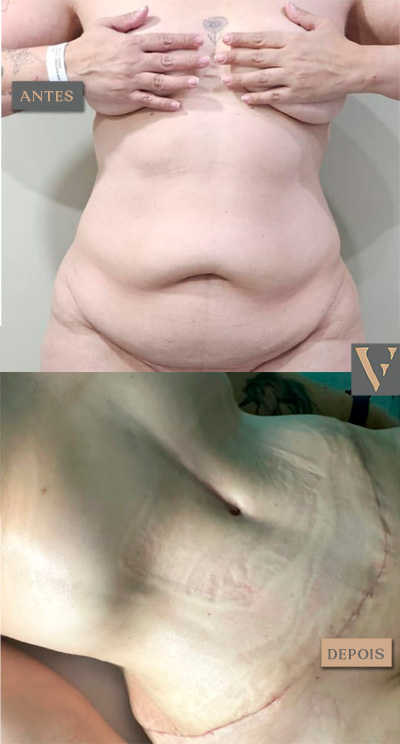 abdominoplastia antes e depois Dr Vitor Francozo