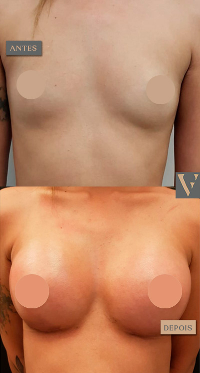 mamoplastia antes e depois Dr Vitor Francozo