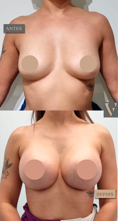 mamoplastia antes edepois Dr Vitor Francozo
