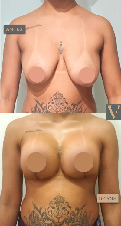 mastopexia antes e depois Dr Vitor Francozo